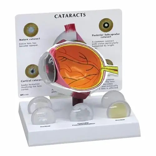 Cataract Eye Model