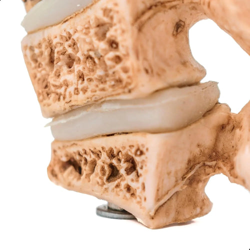 osteoporotic vertebral