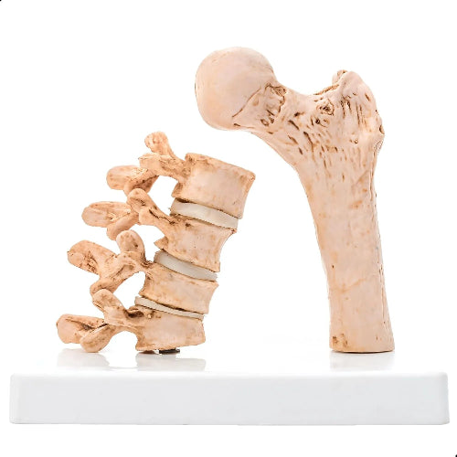 vertebral osteoporosis