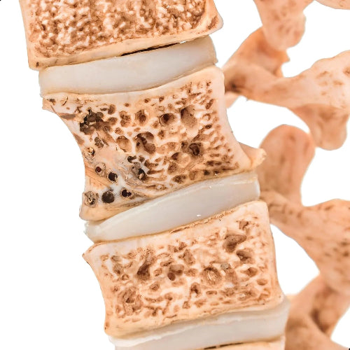 vertebral osteoporosis