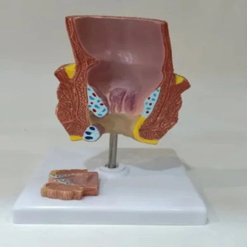 Diseased Rectum Model
