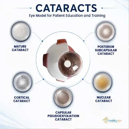 cataract eye model 