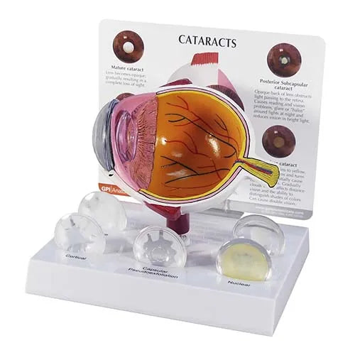 cataract eye model