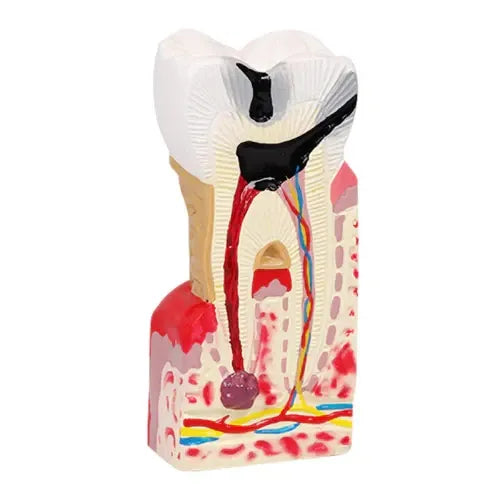 diseased tooth model