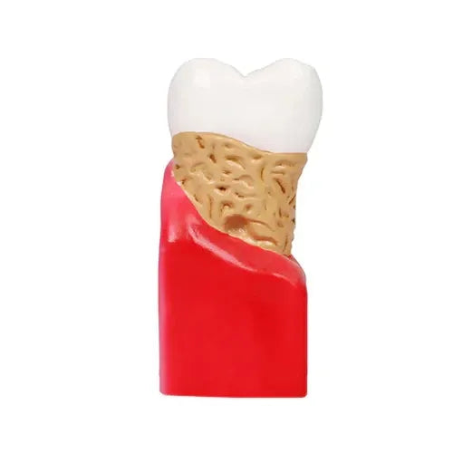 diseased tooth model