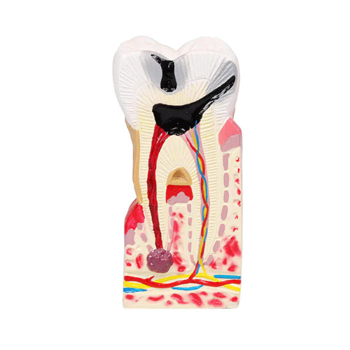 Diseased Tooth Model