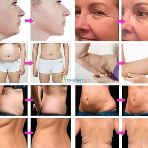 hifu treatment
