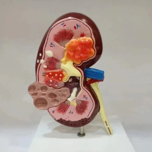 kidney cyst model
