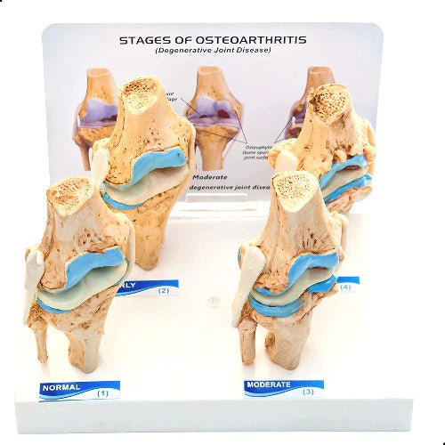 Knee Joint Arthritis Model 4 Stage Osteoarthritis