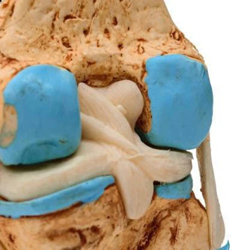 Knee Joint Arthritis Model 4 Stage Osteoarthritis