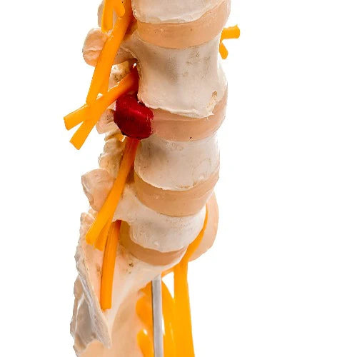 Lumbar Sacrum Spine Model with Herniated DIsc