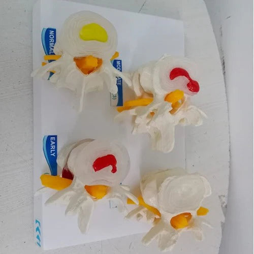 lumbar vertebrae degeneration model