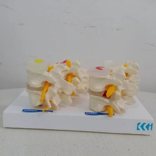 lumbar vertebrae degeneration model