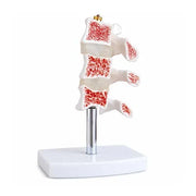 osteoporosis model