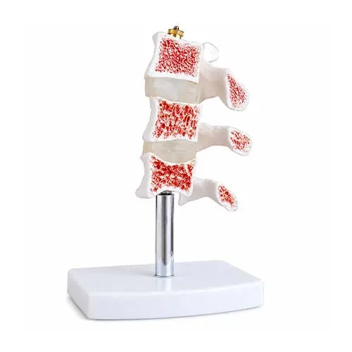 osteoporosis model