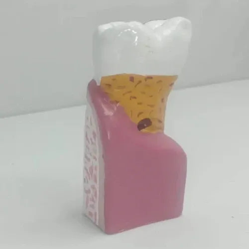 diseased tooth model