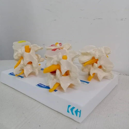 lumbar vertebrae degeneration model